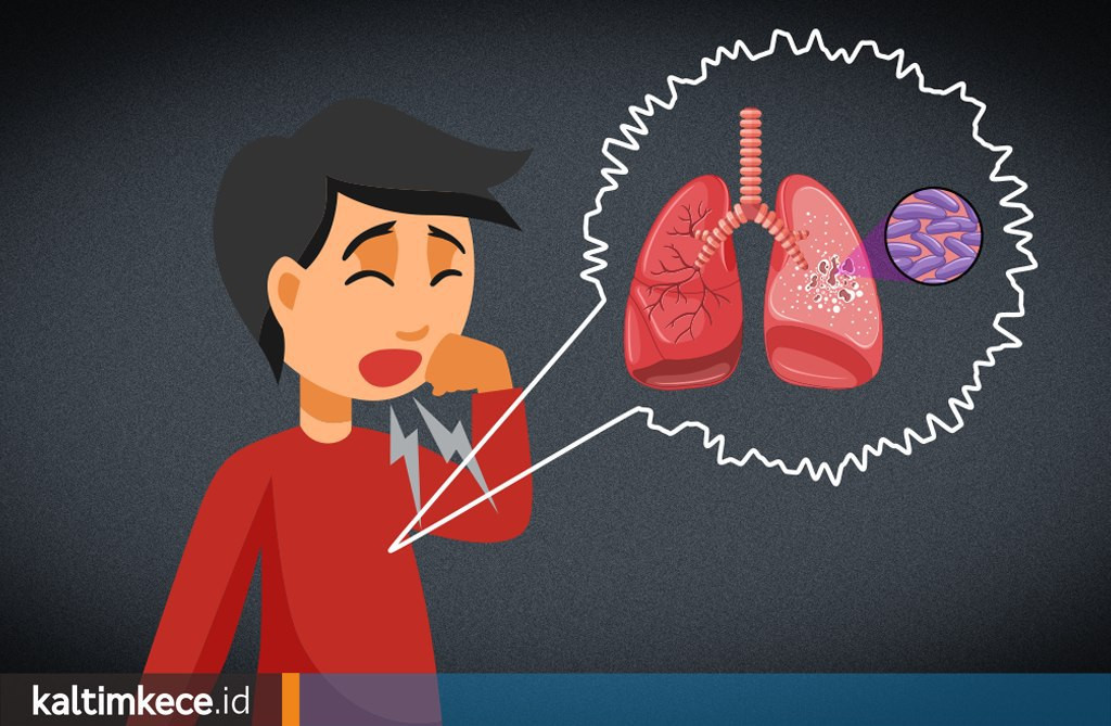 Tuberkulosis, Penyakit yang Lebih Mematikan dari Corona dan Sudah Lama Menyebar di Kaltim